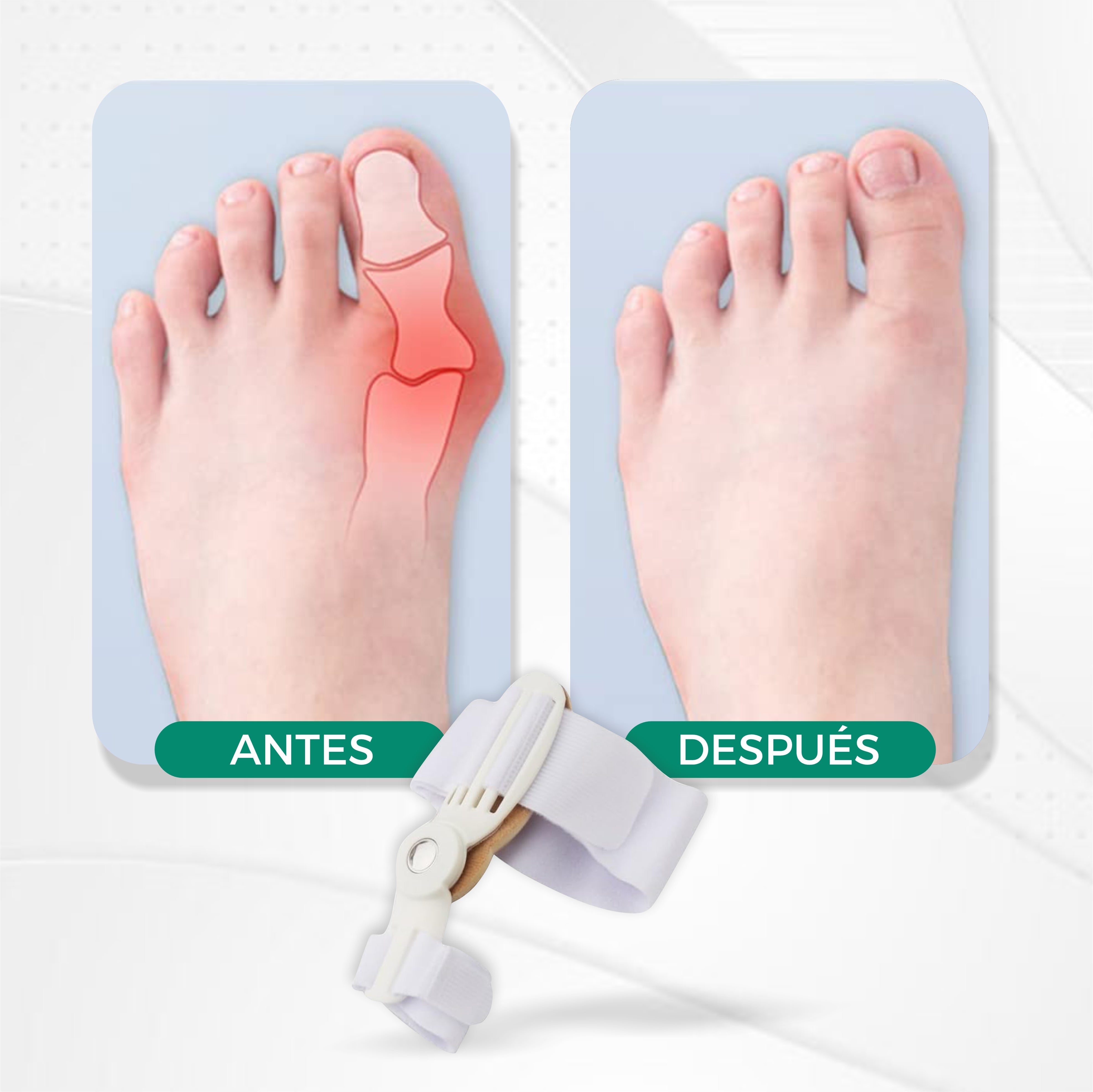 OrtoFlex© -Corrector de Juanetes  